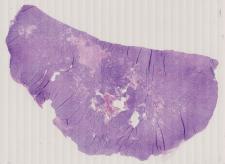 vignette Lame virtuelle : Estomac : Cas n°3 - tumeur maligne -  Tumeurs stromales Gastro-intestinales (GIST)