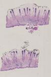 vignette Lame virtuelle : Peau : Cas n°1 - tumeur bénigne - Kératose pré-épithéliomateuse (keratose actinique)