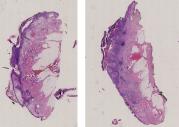vignette Lame virtuelle : Peau : Cas n°5 - tumeur maligne - carcinome epidermoide microinvasif sur malaide de bowen