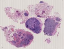 vignette Lame virtuelle : Œsophage : Cas n°1 - tumeur maligne - carcinome épidermoïde peu différencié - métastase