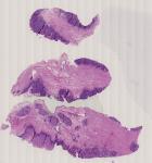 vignette Lame virtuelle : Œsophage : Cas n°4 - tumeur bénigne - endobrachyœsophage avec neoplasie intra-epitheliale glandulaire de haut grade