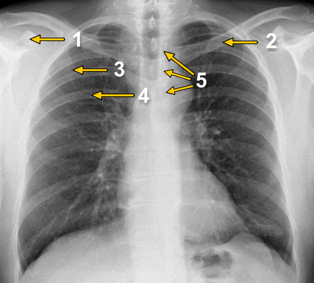 Radiographie du thorax vue de face