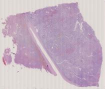 vignette Lame virtuelle : Foie : cas n°1- tumeur maligne - Hépatocarcinome- 