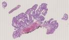vignette Lame virtuelle : Estomac : Cas n°5 - tumeur bénigne - Adenome tubuleux