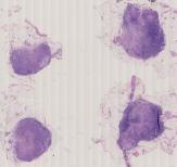 vignette Lame virtuelle : Estomac : Cas n°1 - tumeur maligne -  adénocarcinome peu différencié -  metastases ganglionnaires (GG tronc caelique)