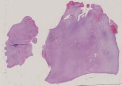 vignette Lame virtuelle : SNC : Cas n°2 - tumeur maligne - astrocytome diffus (grade 2)