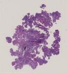 vignette Lame virtuelle : SNC : Cas n°8 - tumeur bénigne - Papillome des plexus choroides