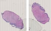 vignette Lame virtuelle : Col de l'utérus : Cas n°2 - tumeur bénigne - CIN 2-3 lésion intra-épithéliale