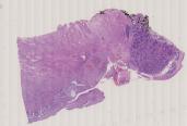 vignette Lame virtuelle : col de l'utérus : Cas n°1 - tumeur maligne - carcinome épidermoïde