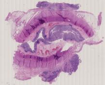 vignette Lame virtuelle : Ovaire : Cas n°1 - tumeur maligne - adénocarcinome papillaire séreux - Nodule péricolique