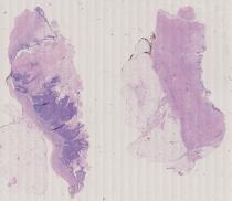 vignette Lame virtuelle : Uretère : Cas n°1 - tumeur maligne - carcinome urothelial grade 3