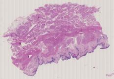 vignette Lame virtuelle : Vessie : Cas n°3 - tumeur maligne - carcinome urothelial papillaire transforme sur carcinome in situ