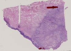 vignette Lame virtuelle : Oropharynx : Cas n°1 - tumeur maligne - carcinome épidermoïde moyennement différencié