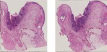 vignette Lame virtuelle : Hypopharynx : Cas n°2 - tumeur maligne - carcinome épidermoïde moyennement différencié 