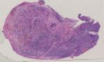 vignette Lame virtuelle : rhinopharynx : cas n°3 - tumeur maligne - Neuroblastome olfactif