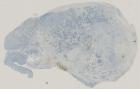 vignette Lame virtuelle : rhinopharynx : cas n°3 - tumeur maligne - Neuroblastome olfactif - PS 100