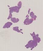 vignette Lame virtuelle : Rhinopharynx : Cas n°5 - tumeur maligne - Lymphome B diffus à grandes cellules